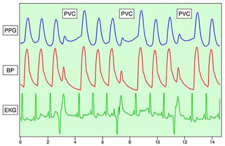 PPG 可以检测心室早发性收缩等异常心脏活动的图片