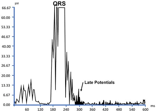 QRS 波群期间出现的 ECG 结果图